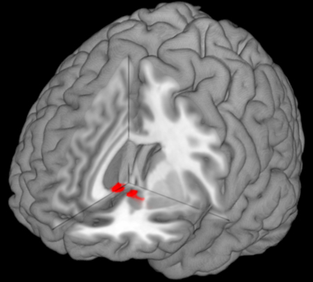3D Brain image (Nucleus Accumbens in red)